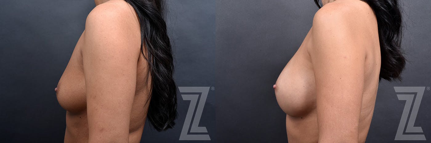 Breast Augmentation Before & After Gallery - Patient 191224114 - Image 5