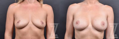Austin 35-Year-Old Mother of Two Young Children Before & After Breast Augmentation in Austin, TX - The Piazza Center