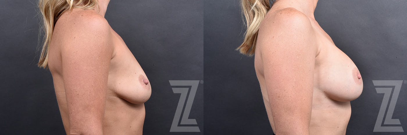 Breast Augmentation Before & After Gallery - Patient 257329 - Image 3
