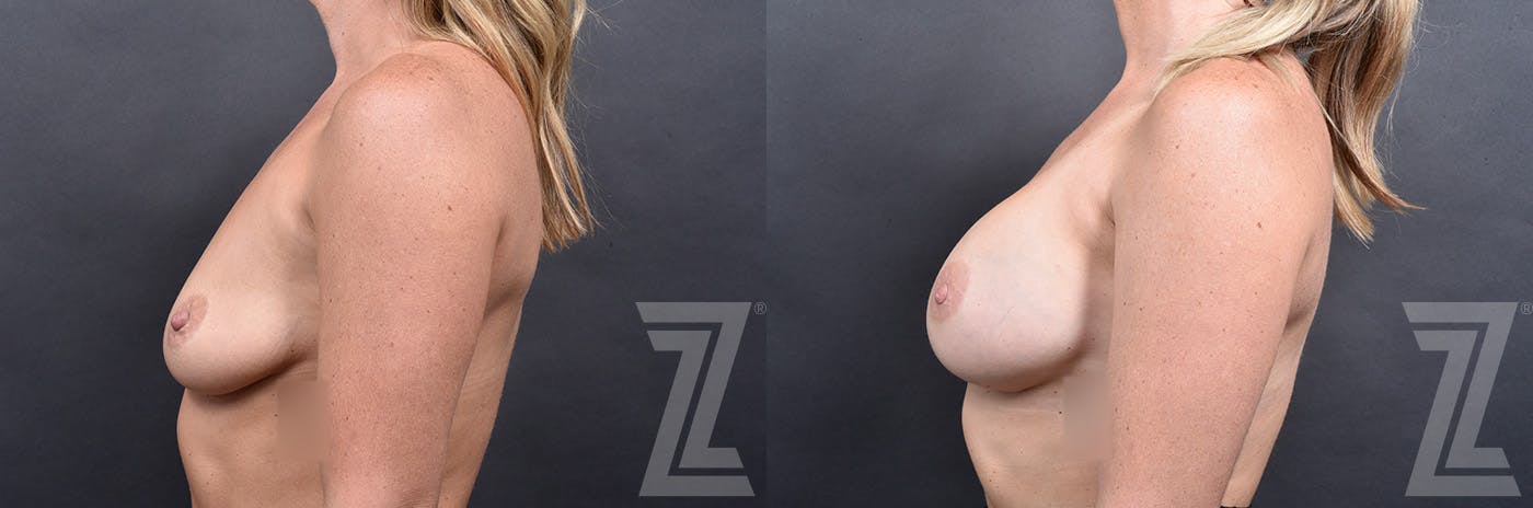 Breast Augmentation Before & After Gallery - Patient 257329 - Image 5
