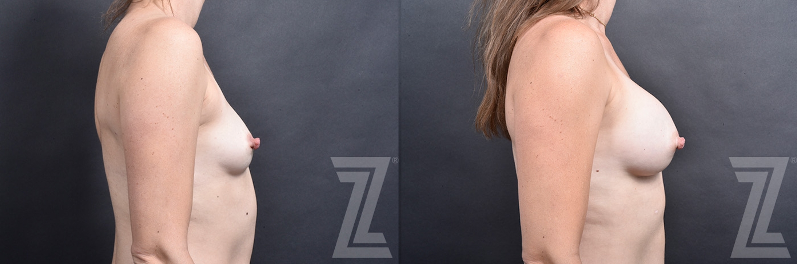 Austin Lateral View Bilateral Breast Augmentation with Right breast Nipple Reduction Before & After in Austin, TX - The Piazza Center - The Piazza Center