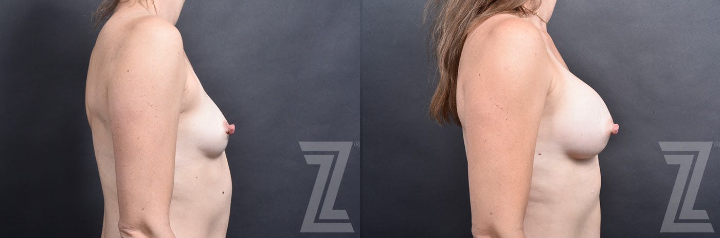 Breast Augmentation Before & After Gallery - Patient 837118 - Image 3