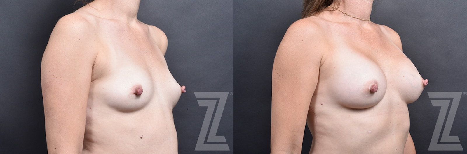 Austin Oblique View Bilateral Breast Augmentation with Right breast Nipple Reduction Before & After in Austin, TX - The Piazza Center - The Piazza Center