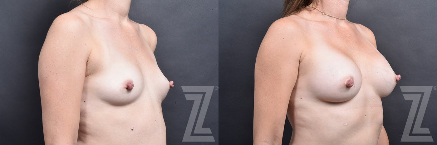 Breast Augmentation Before & After Gallery - Patient 837118 - Image 2