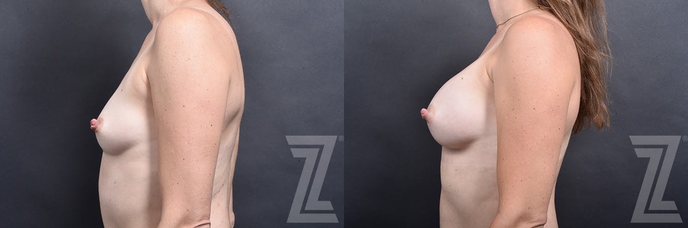 Breast Augmentation Before & After Gallery - Patient 837118 - Image 5