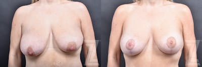 Austin Frontal View Breast Augmentation Before & After in Austin, TX at The Piazza Center - The Piazza Center