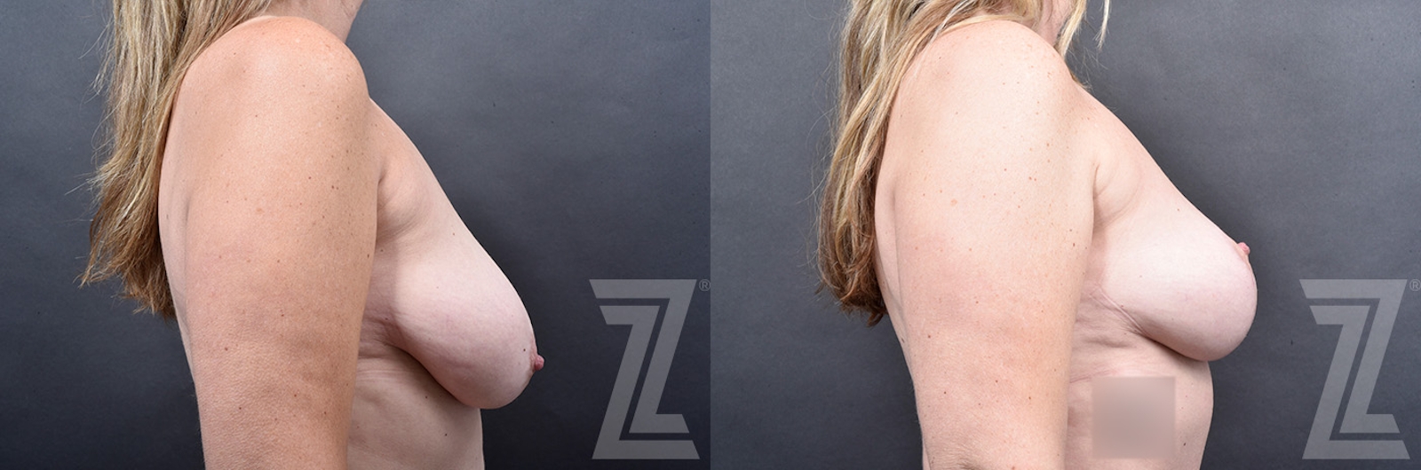 Austin Breast Lift Before & After Gallery - Patient 778016 - Image 3 - The Piazza Center