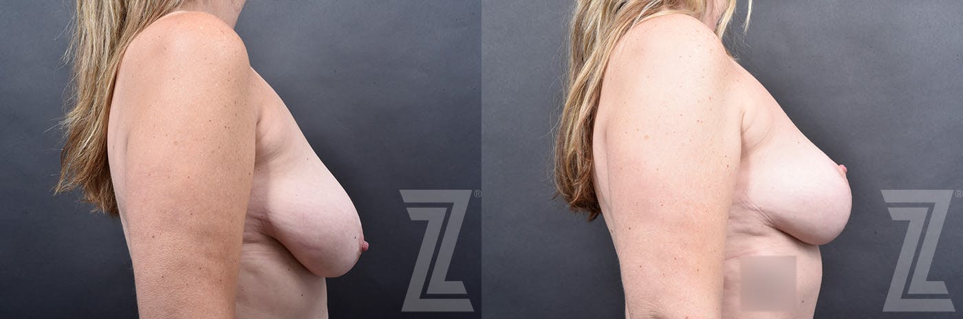 Breast Lift Before & After Gallery - Patient 778016 - Image 3