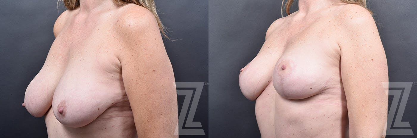 Breast Lift Before & After Gallery - Patient 778016 - Image 4