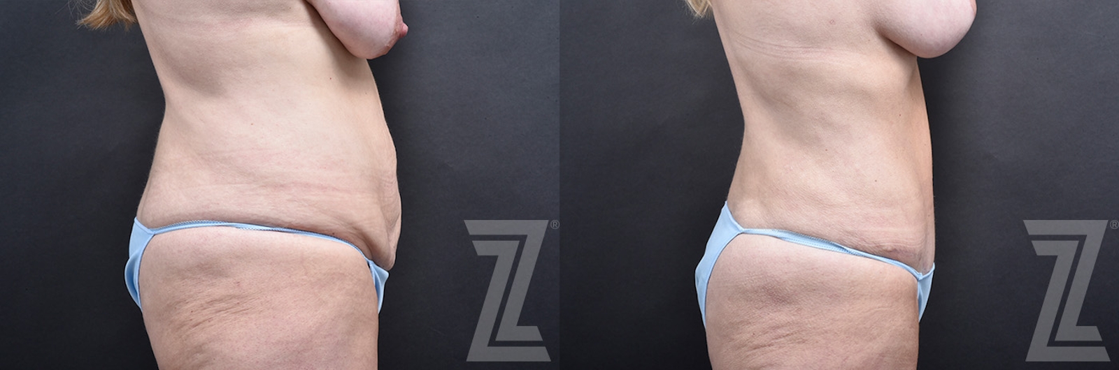 Austin Tummy Tuck Before & After Gallery - Patient 803424 - Image 1 - The Piazza Center