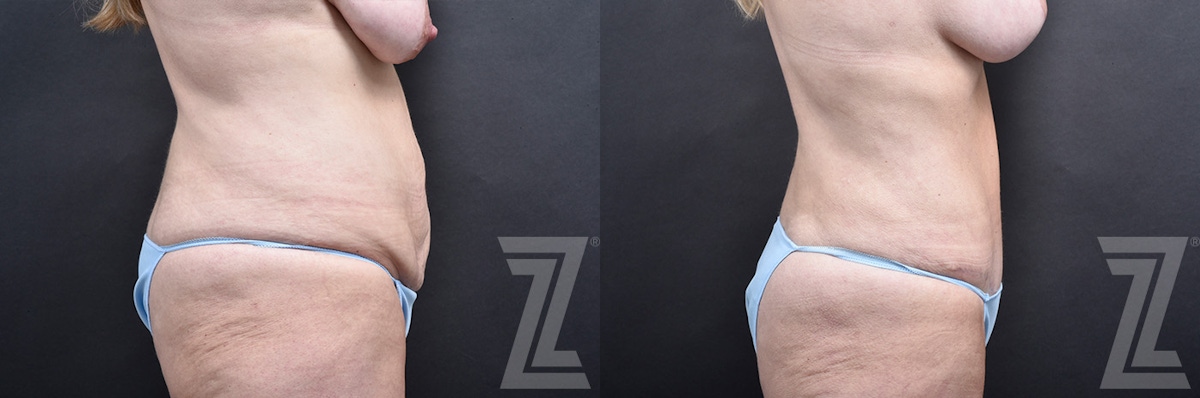 Austin Tummy Tuck Before & After Gallery - Patient 803424 - Image 1 - The Piazza Center