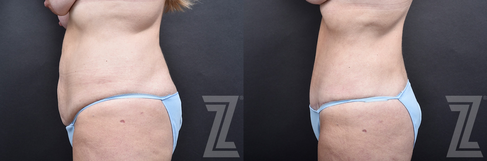 Austin Tummy Tuck Before & After Gallery - Patient 803424 - Image 2 - The Piazza Center