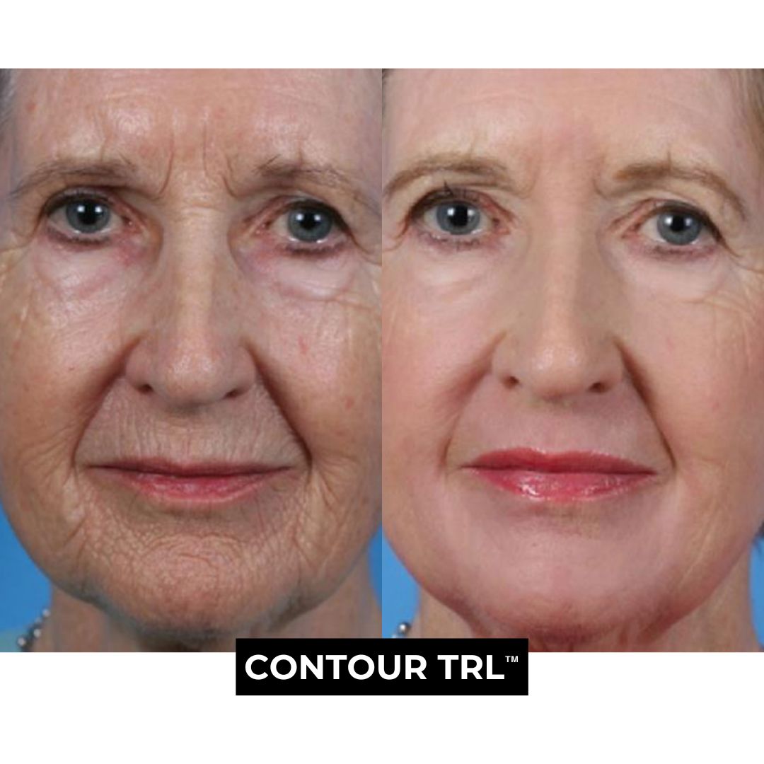 Contour TRL Before and After