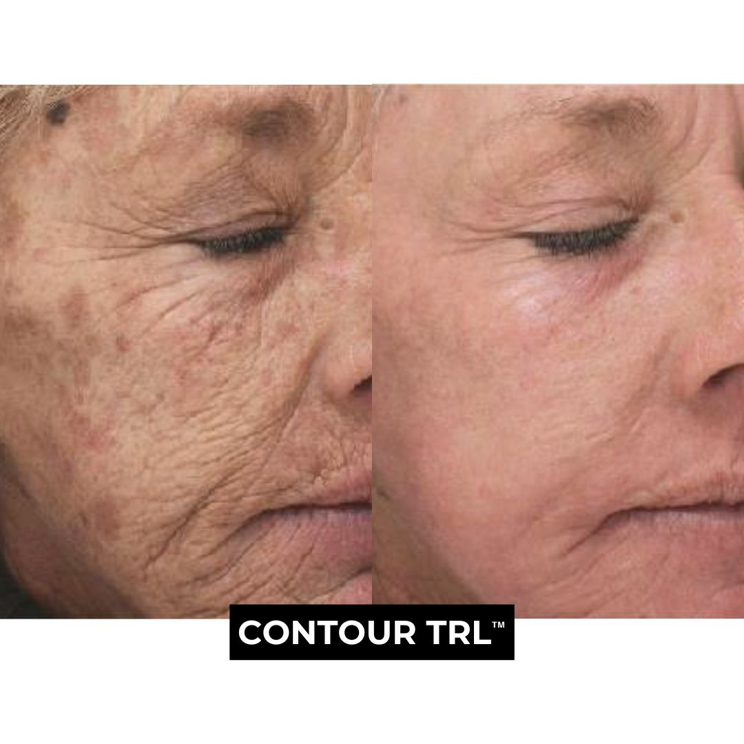 Contour TRL Treatment Before and After