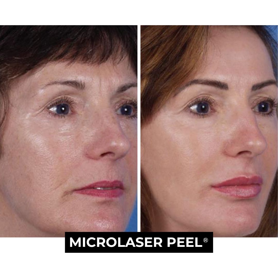 Micro Laser Peel Before and After