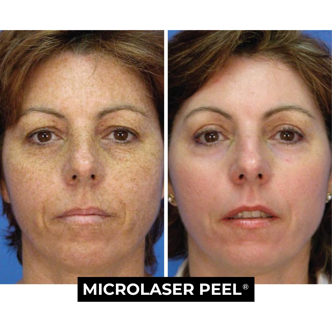 Before and After Micro Laser Peel Benefits