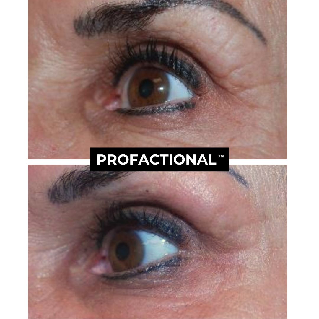 Profractional Laser Austin Before and After