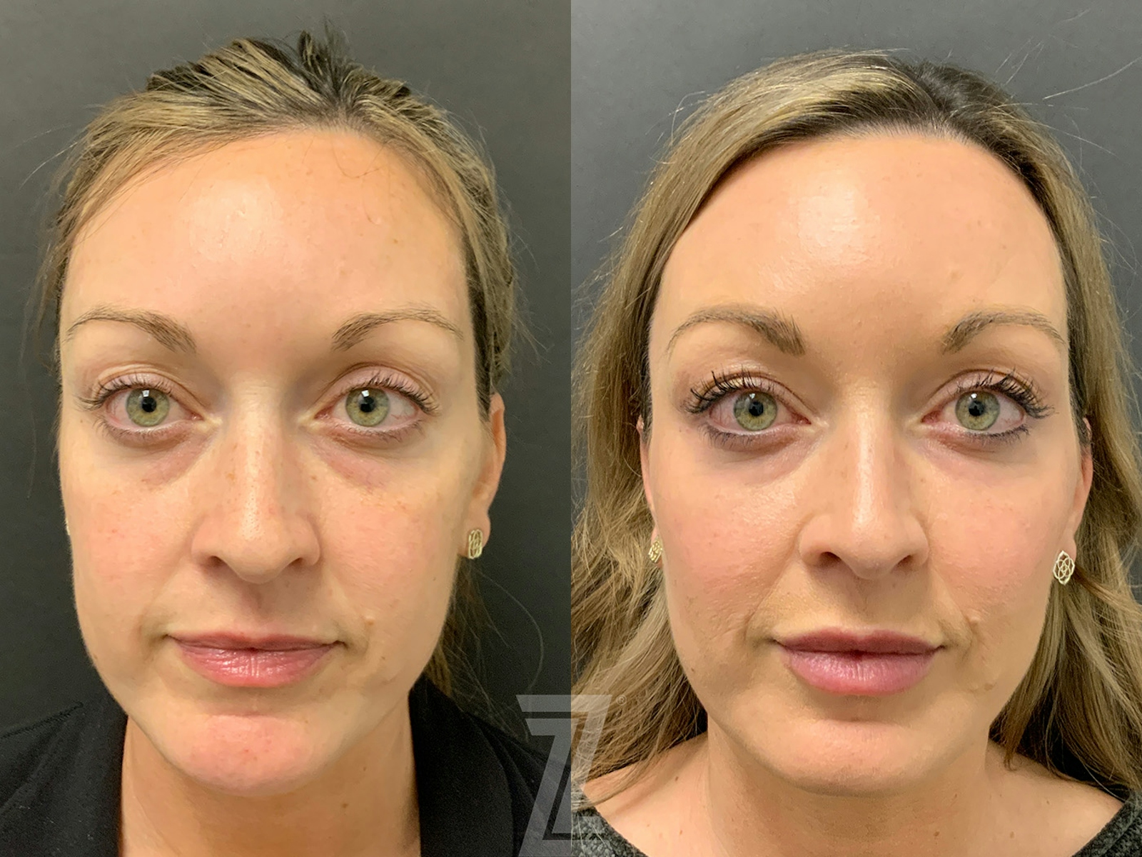 Austin Injectable Fillers Before & After Gallery - Patient 179698 - Image 1 - The Piazza Center