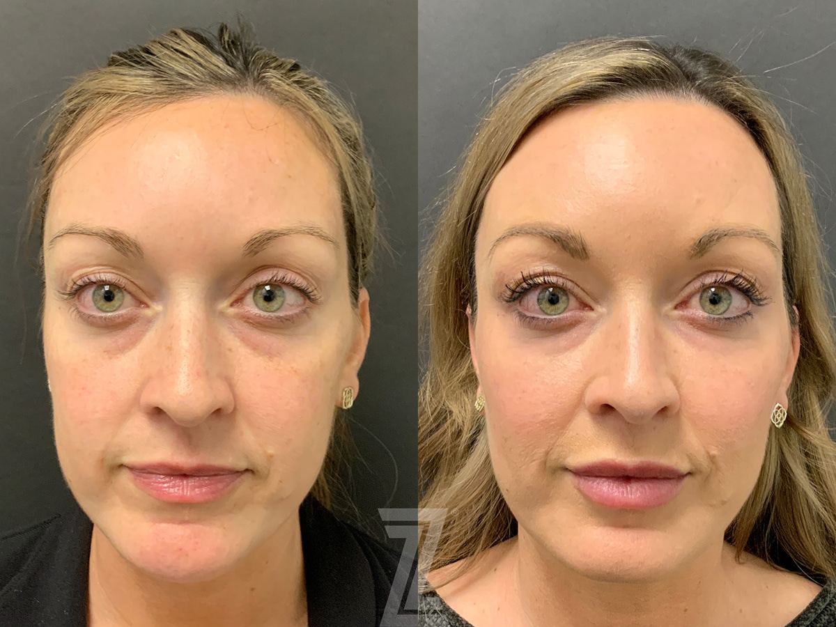 Austin Injectable Fillers Before & After Gallery - Patient 179698 - Image 1 - The Piazza Center