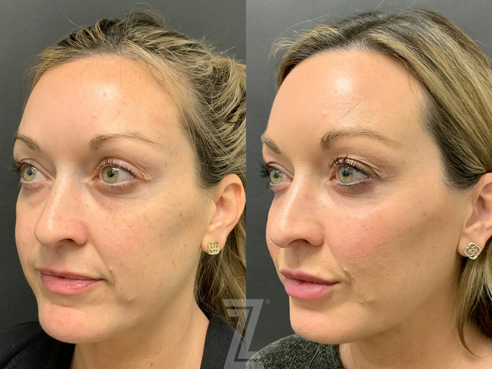 Austin Injectable Fillers Before & After Gallery - Patient 179698 - Image 2 - The Piazza Center