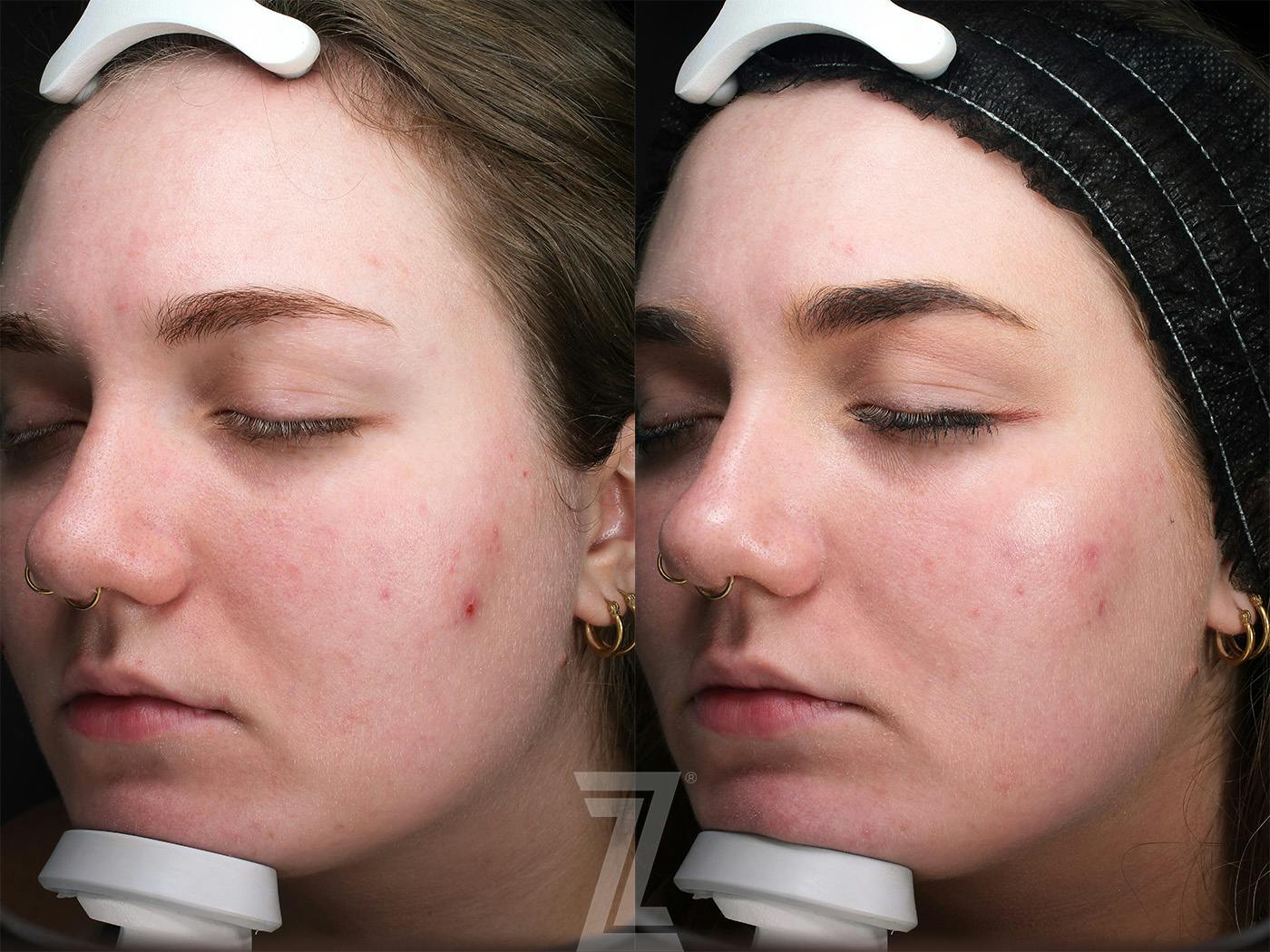 Clear Skin Protocol Before & After Gallery - Patient 348532 - Image 2