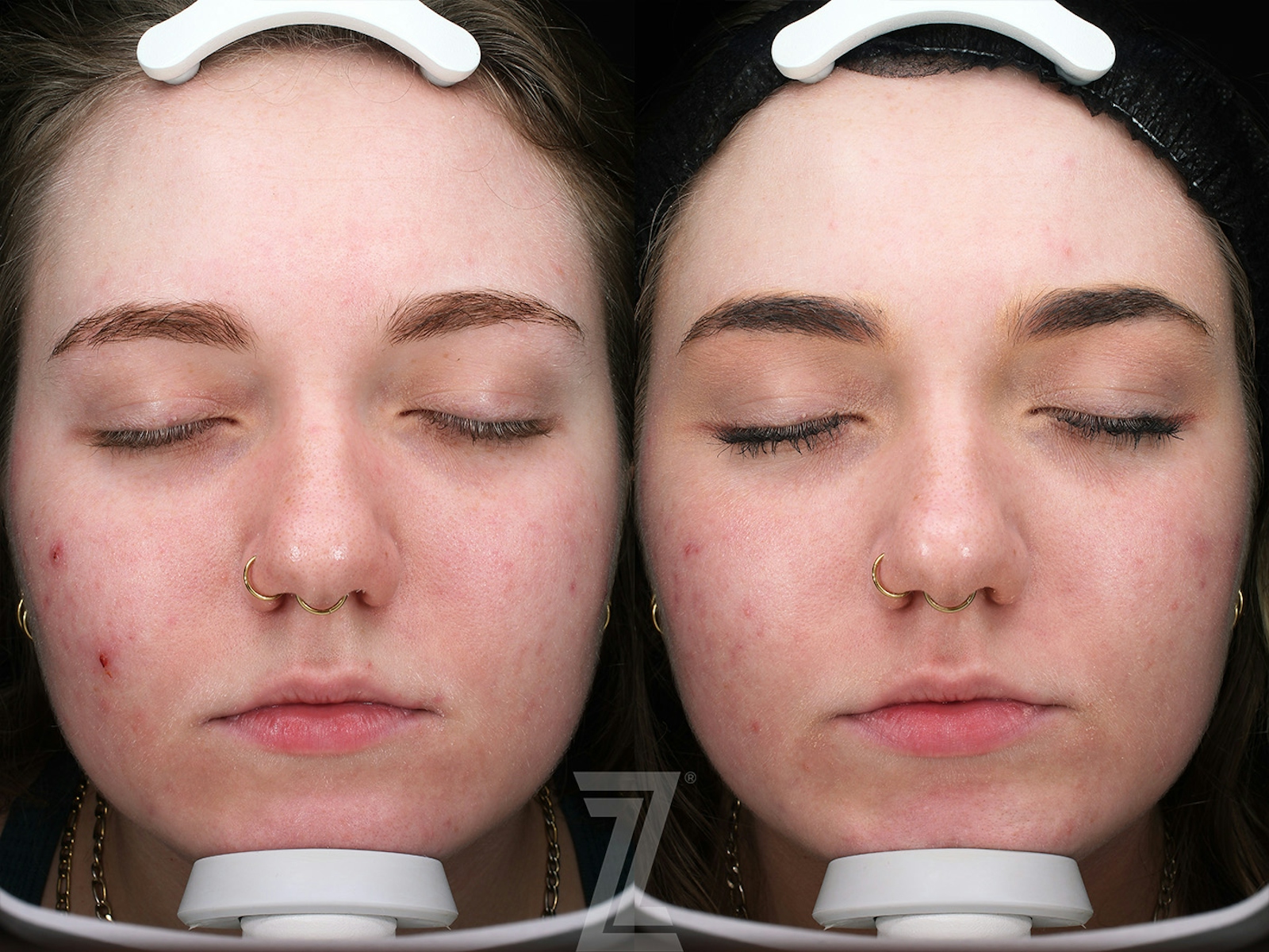 Austin Clear Skin Protocol Before & After Gallery - Patient 348532 - Image 1 - The Piazza Center