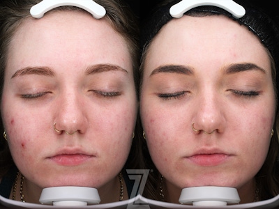Clear Skin Protocol Before & After Gallery - Patient 348532 - Image 1