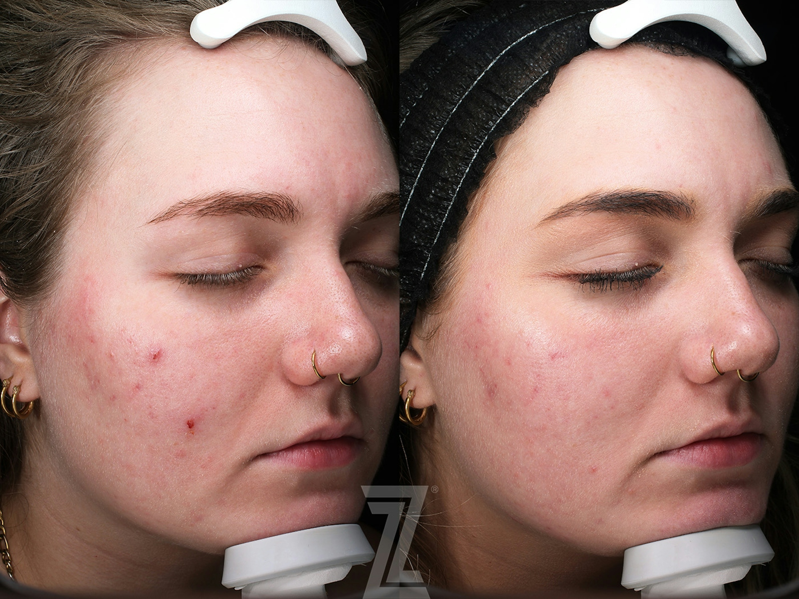 Austin Clear Skin Protocol Before & After Gallery - Patient 348532 - Image 3 - The Piazza Center