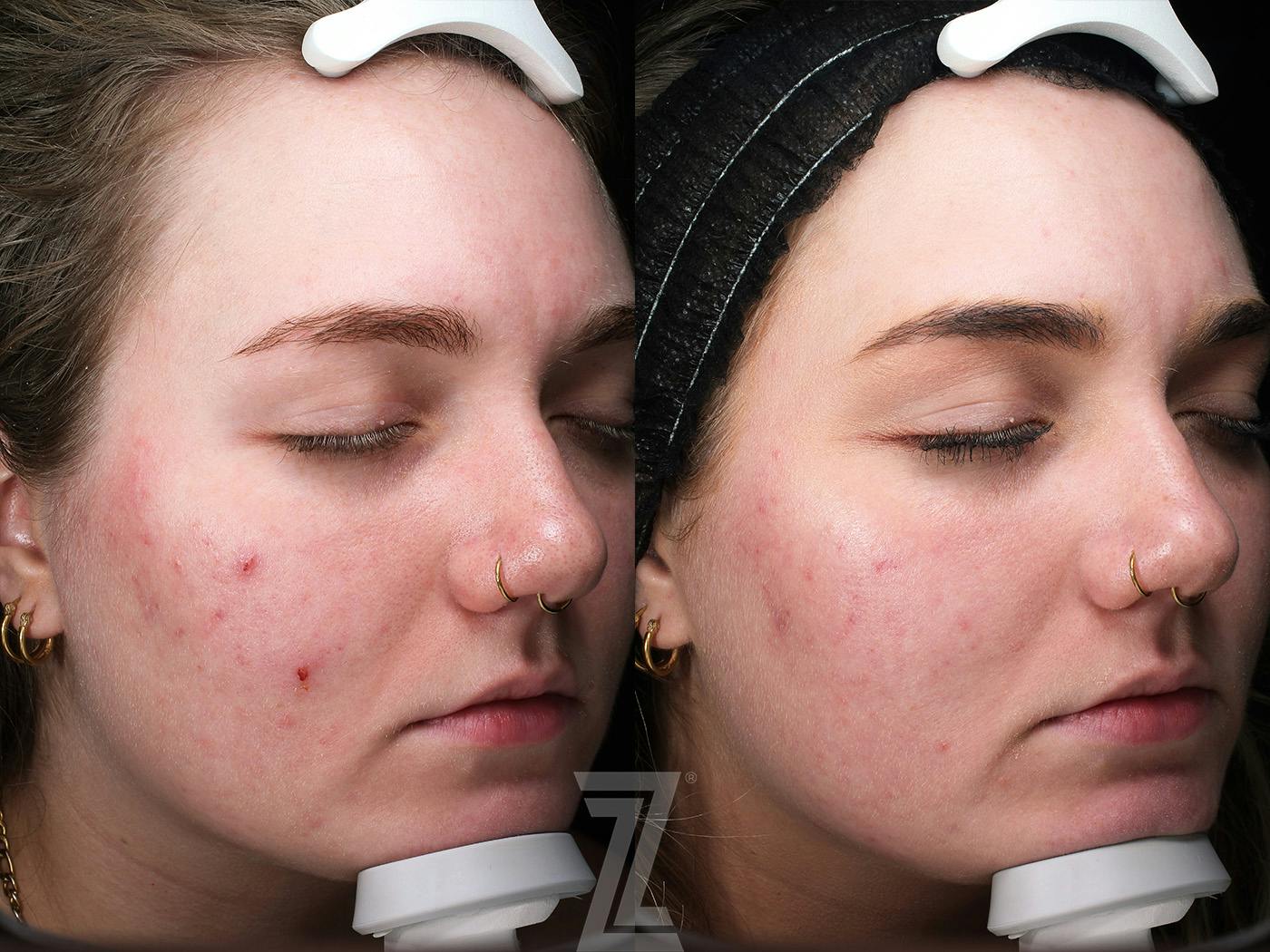 Clear Skin Protocol Before & After Gallery - Patient 348532 - Image 3