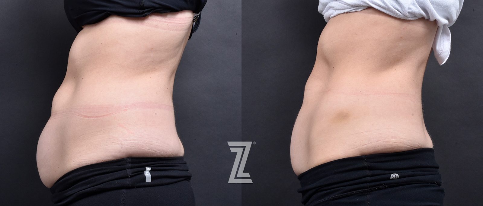 Austin Emsulpt Neo® Before & After Gallery - Patient 408749 - Image 2 - The Piazza Center