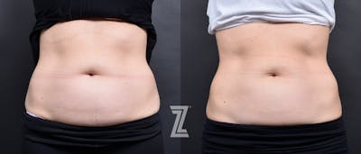 Austin Emsulpt Neo® Before & After Gallery - Patient 408749 - Image 1 - The Piazza Center