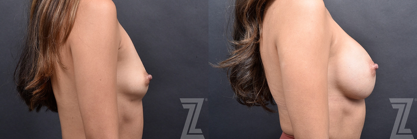 Austin Side View 1 Year Transformation Before & After Breast Augmentation at The Piazza Center in Austin - Dr. Rocco Piazza - The Piazza Center