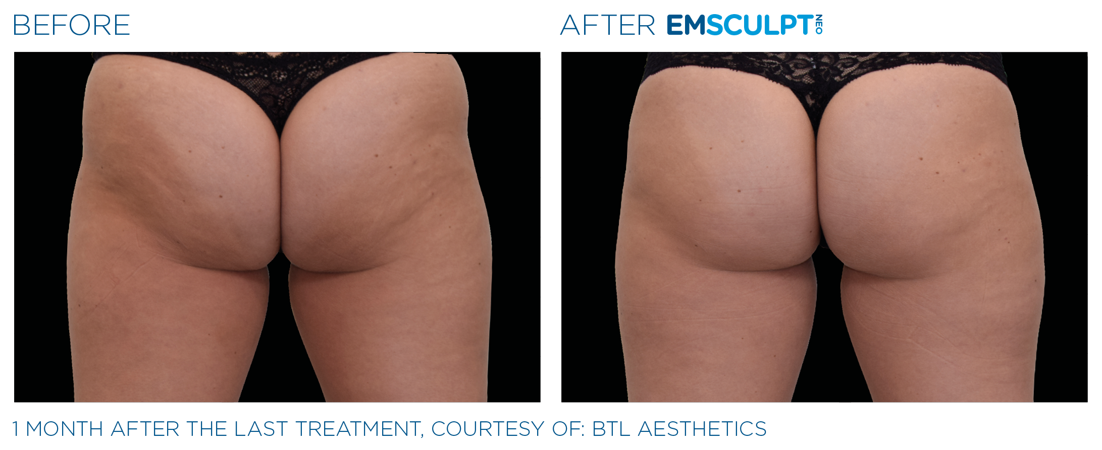 emsculpt to help lift buttocks - ozempic butt