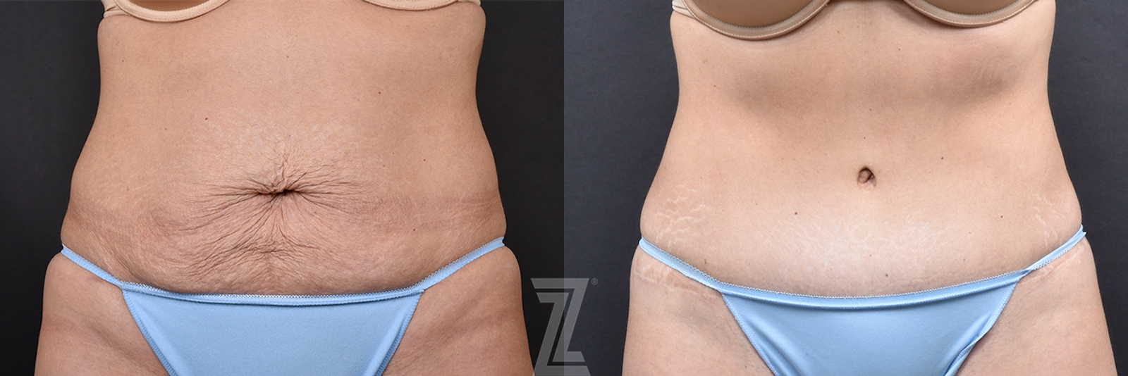 Austin Front View of 39-Year-Old Female Patient Mommy Makeover Before & Afters in Austin, TX - The Piazza Center - Dr. Rocco Piazza - The Piazza Center