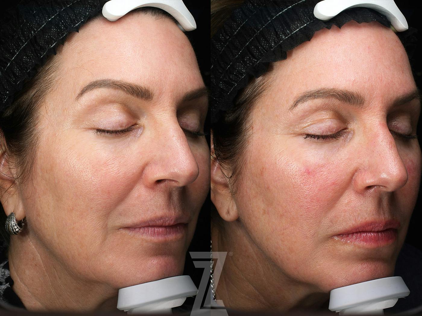 Patient 381677 | BBL Before & After Photos | The Piazza Center