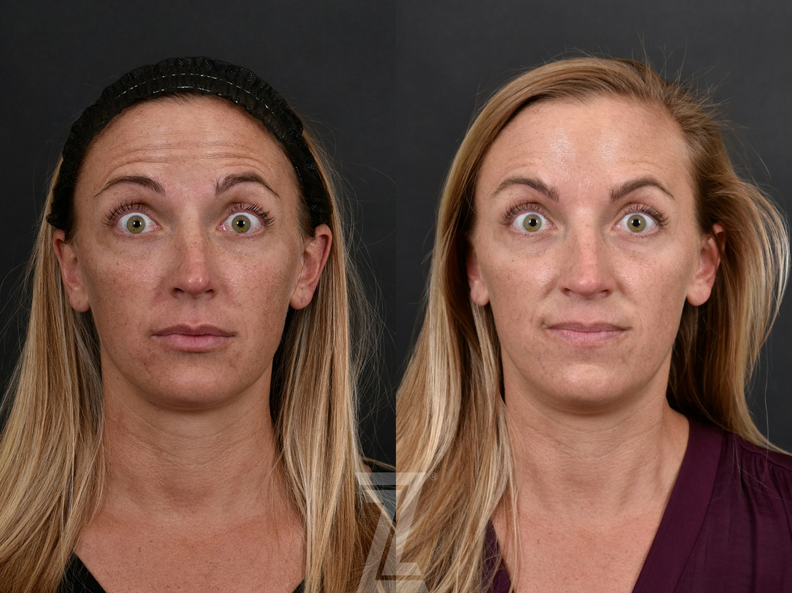 Austin Wrinkle Relaxers Before & After Gallery - Patient 660735 - Image 2 - The Piazza Center