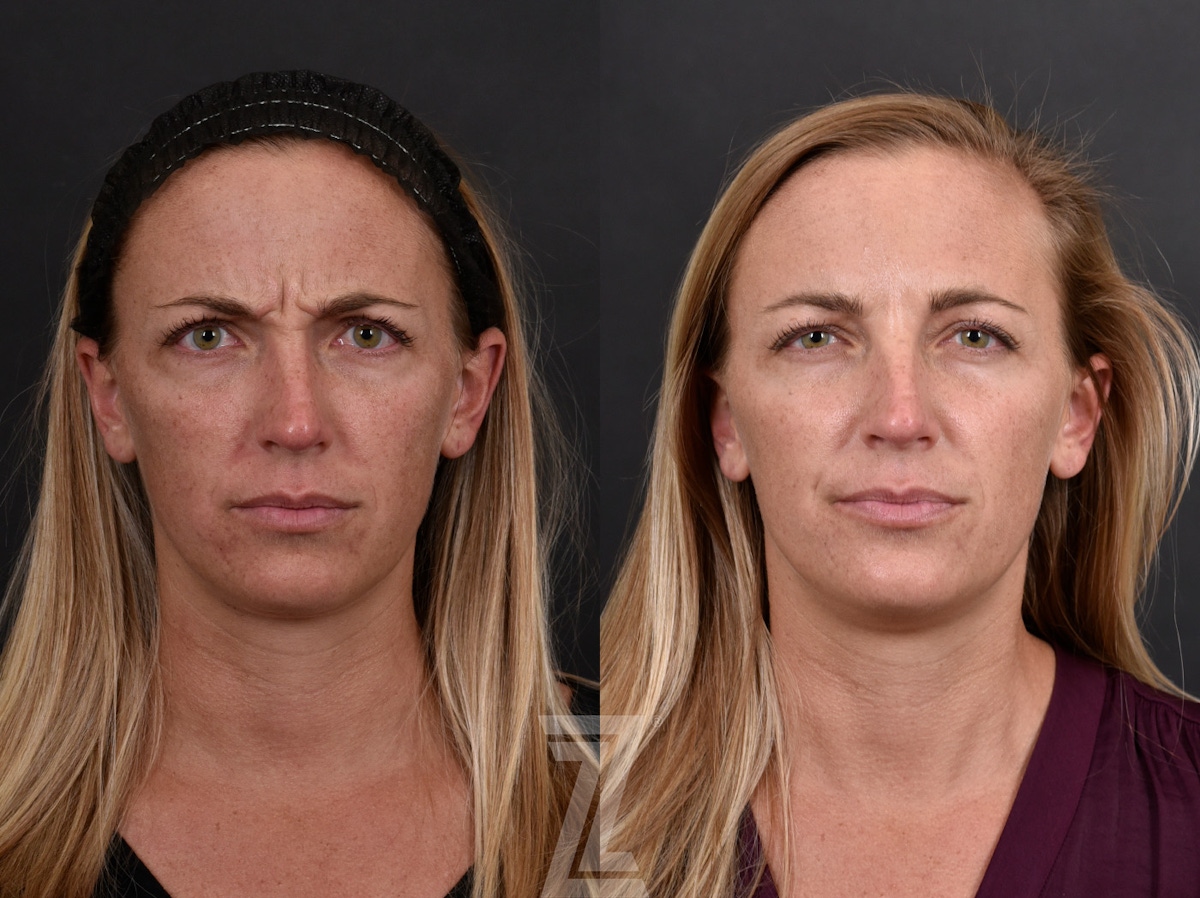 Austin Wrinkle Relaxers Before & After Gallery - Patient 660735 - Image 1 - The Piazza Center
