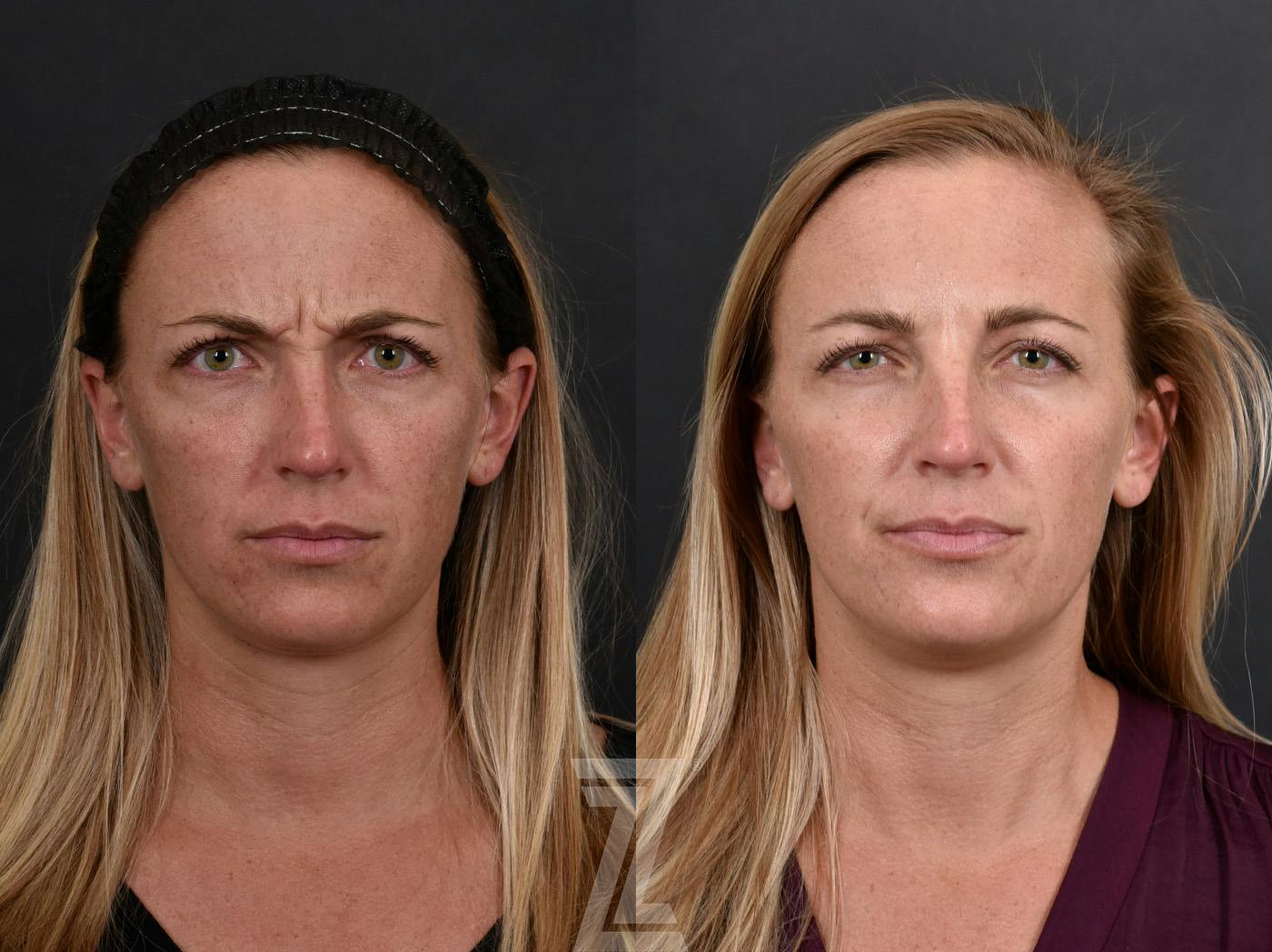 Wrinkle Relaxers Before & After Gallery - Patient 660735 - Image 1