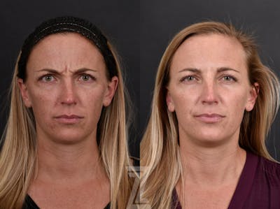 Austin Wrinkle Relaxers Before & After Gallery - Patient 660735 - Image 1 - The Piazza Center