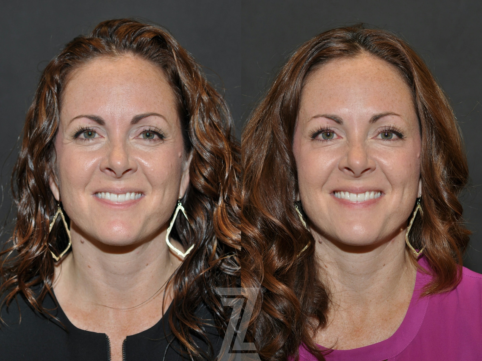 Austin Wrinkle Relaxers Before & After Gallery - Patient 293402 - Image 1 - The Piazza Center