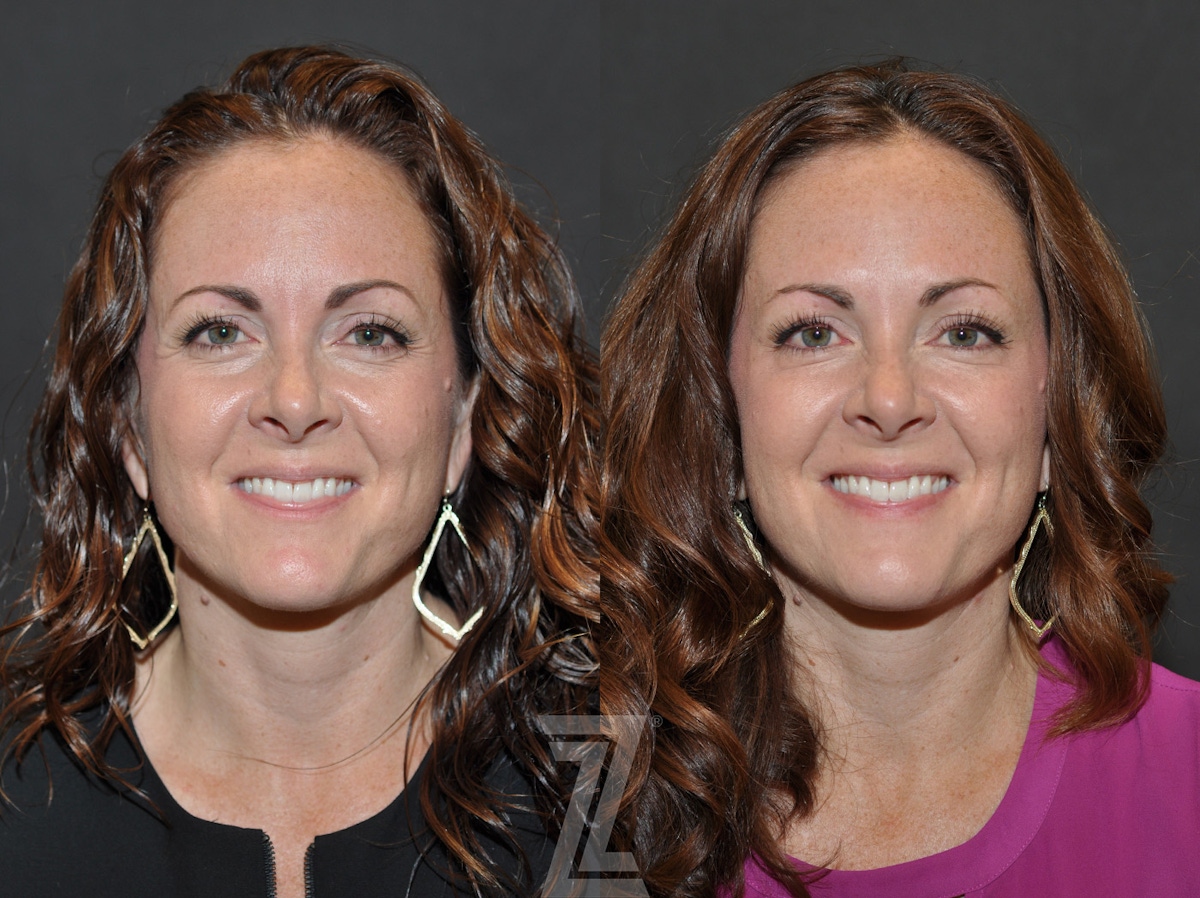 Austin Wrinkle Relaxers Before & After Gallery - Patient 293402 - Image 1 - The Piazza Center