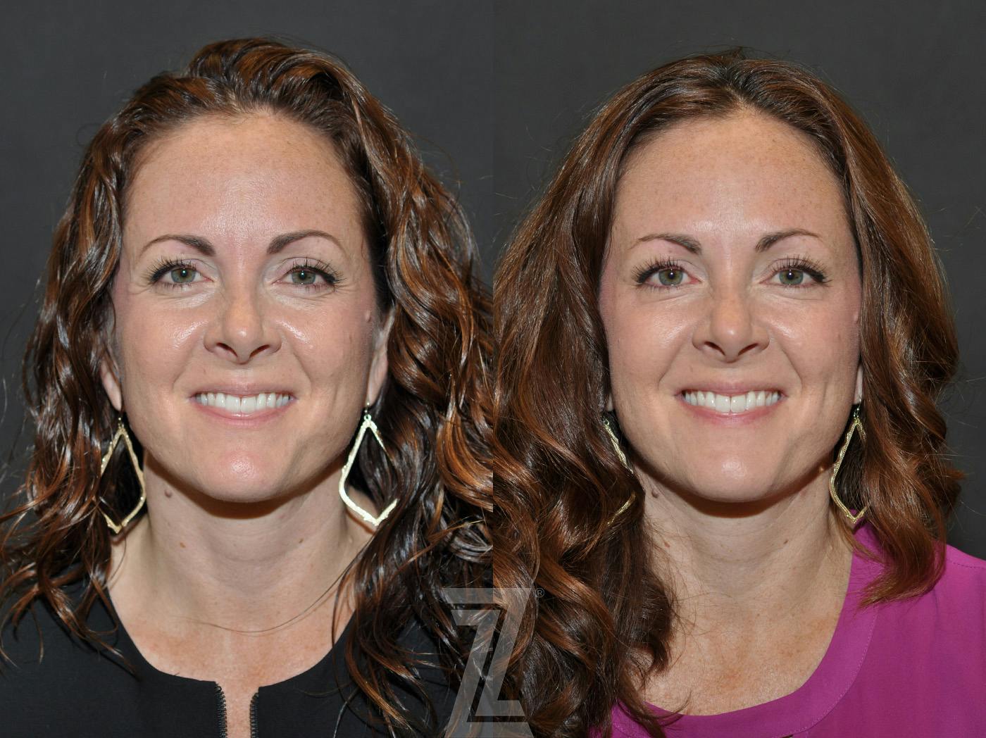 Wrinkle Relaxers Before & After Gallery - Patient 293402 - Image 1