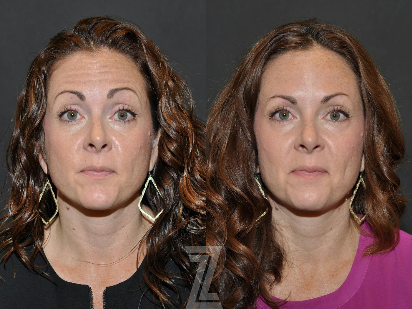 Wrinkle Relaxers Before & After Gallery - Patient 293402 - Image 3