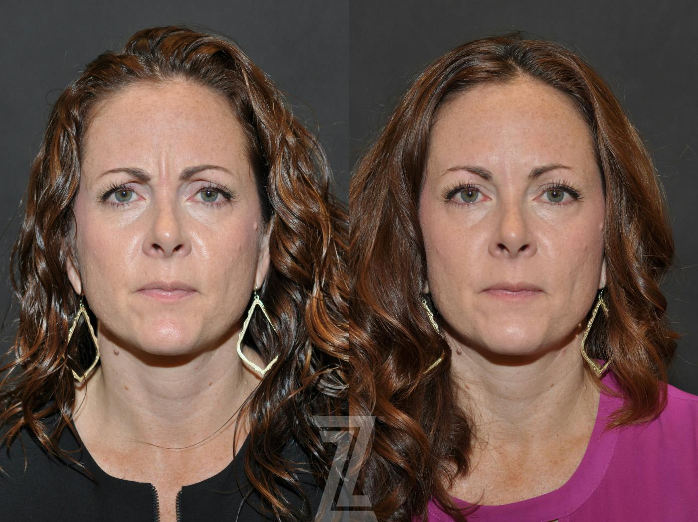 Wrinkle Relaxers Before & After Gallery - Patient 293402 - Image 2