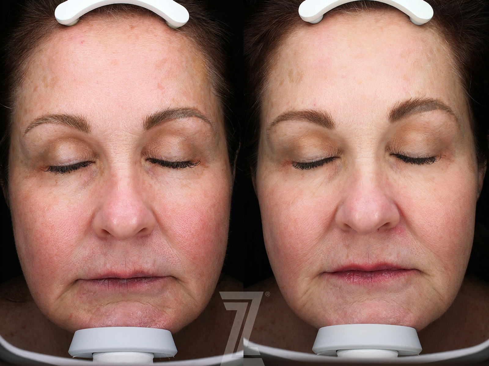 Austin HALO Before & After Gallery - Patient 367769 - Image 1 - The Piazza Center