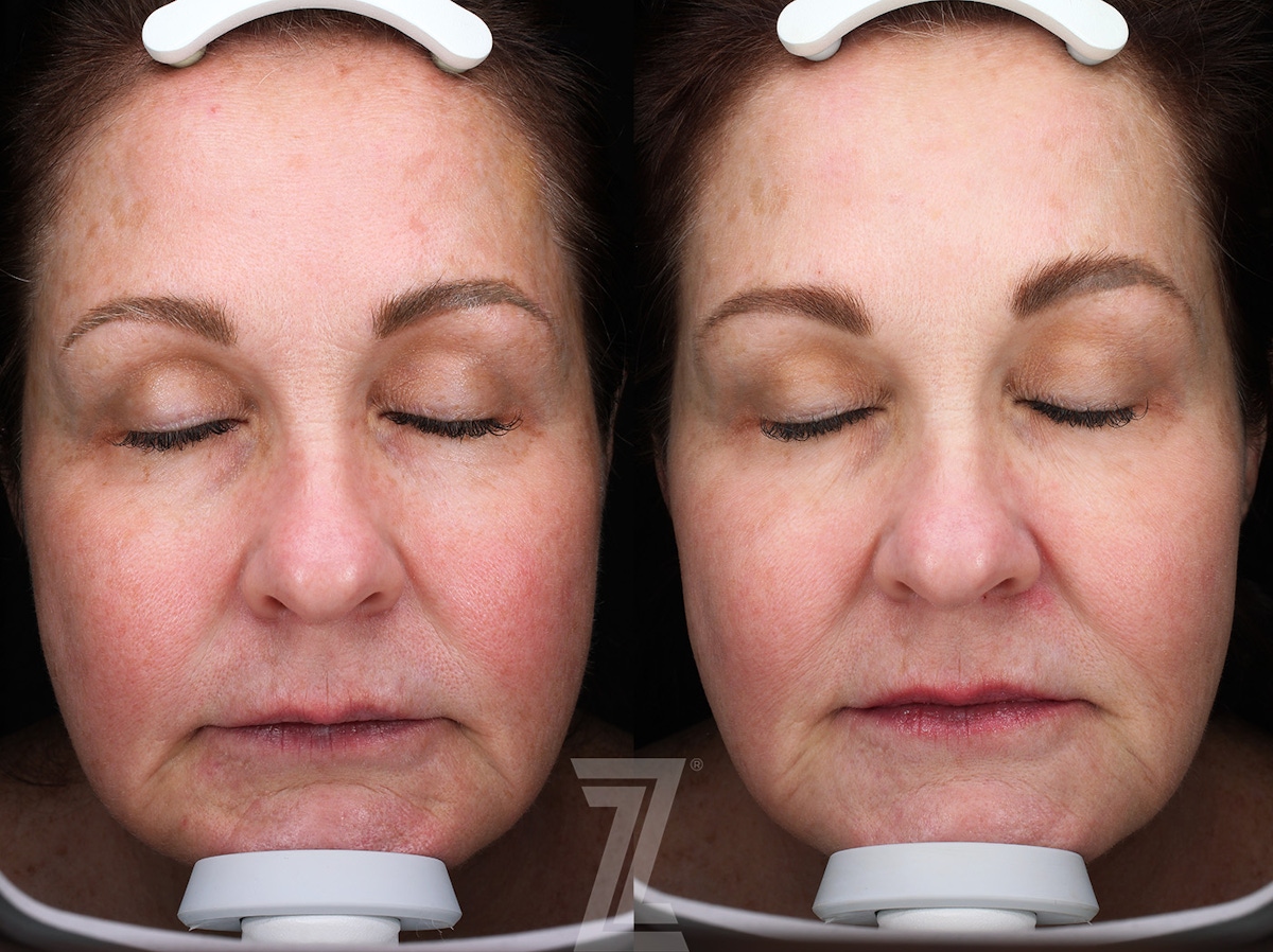 Austin HALO Before & After Gallery - Patient 367769 - Image 1 - The Piazza Center