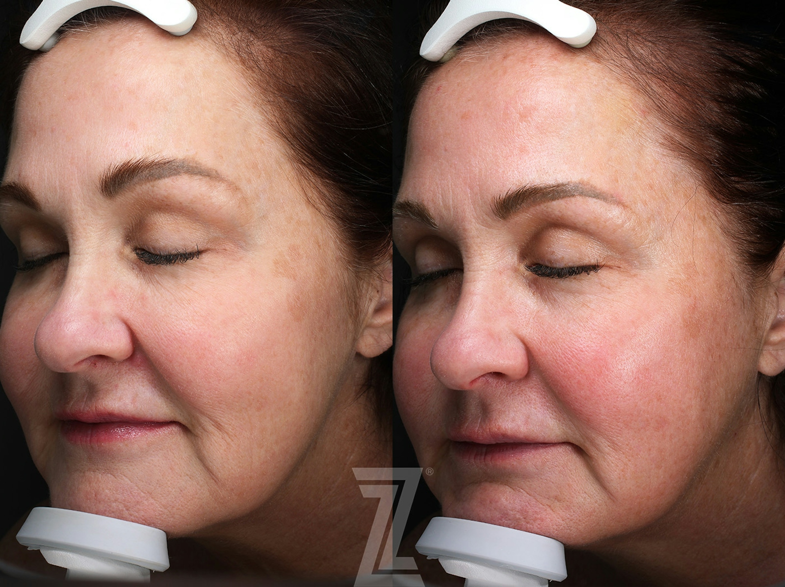 Austin HALO Before & After Gallery - Patient 367769 - Image 3 - The Piazza Center