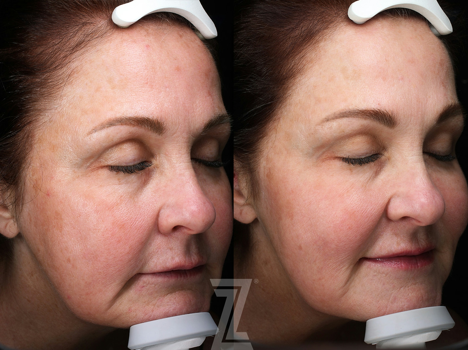 Austin HALO Before & After Gallery - Patient 367769 - Image 2 - The Piazza Center
