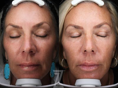Austin SkinPen Microneedling Before & After Gallery - Patient 362150 - Image 1 - The Piazza Center