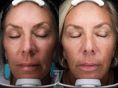 Profound® RF Microneedling Before & After Gallery - Patient 365285 - Image 1